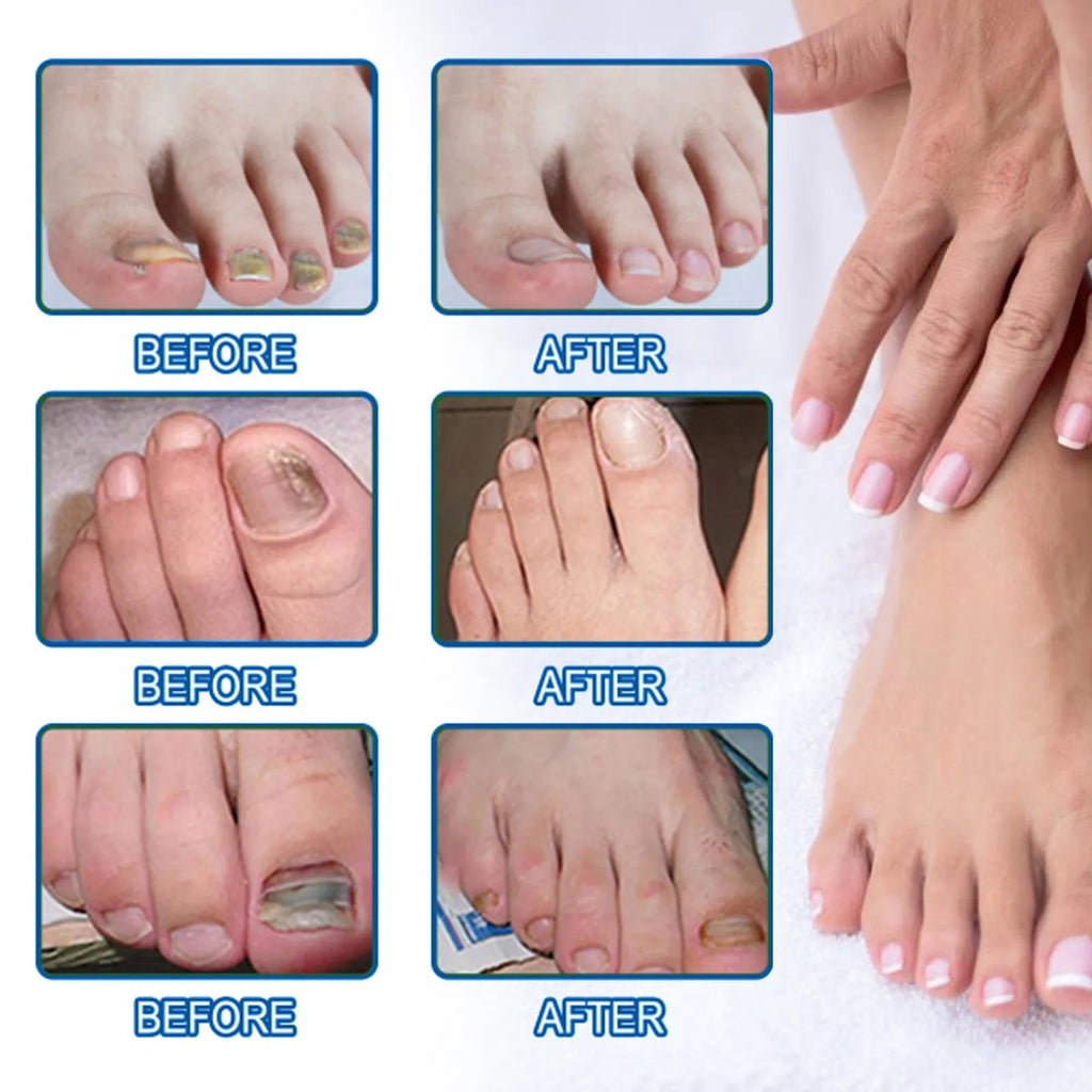 Box of 32 nail repair adhesive bandages with glycerin and tea tree oil, each measuring 6.1 by 3.5 centimetres