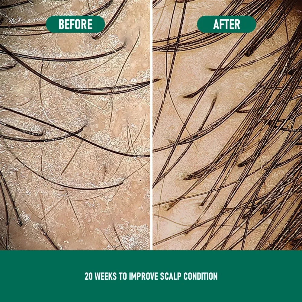 Minoxidil 5% anti-hair loss foam mousse bottle with scalp applicator for hair regrowth treatment