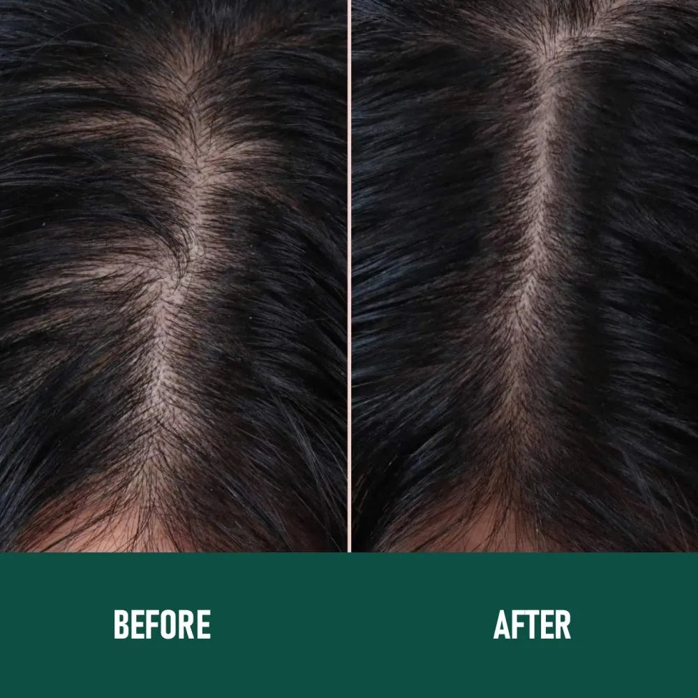 Minoxidil 5% anti-hair loss foam mousse bottle with scalp applicator for hair regrowth treatment