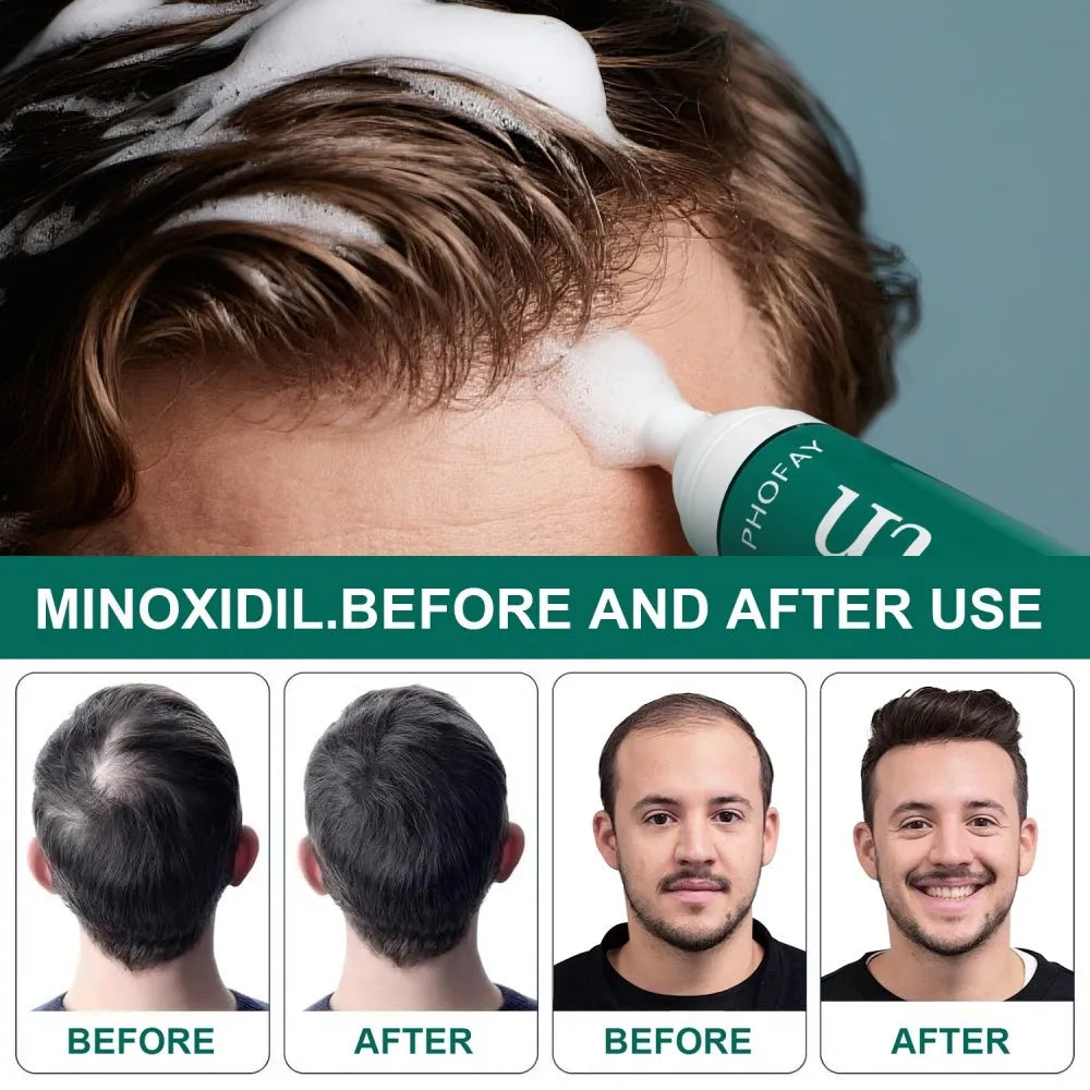 Minoxidil 5% anti-hair loss foam mousse bottle with scalp applicator for hair regrowth treatment