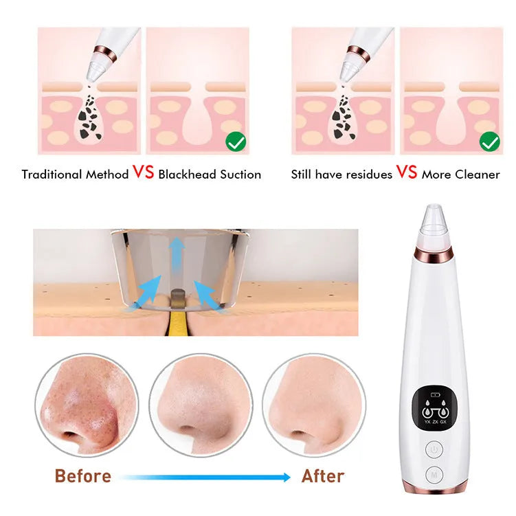 White facial instrument cleanser with vacuum suction head for blackhead removal