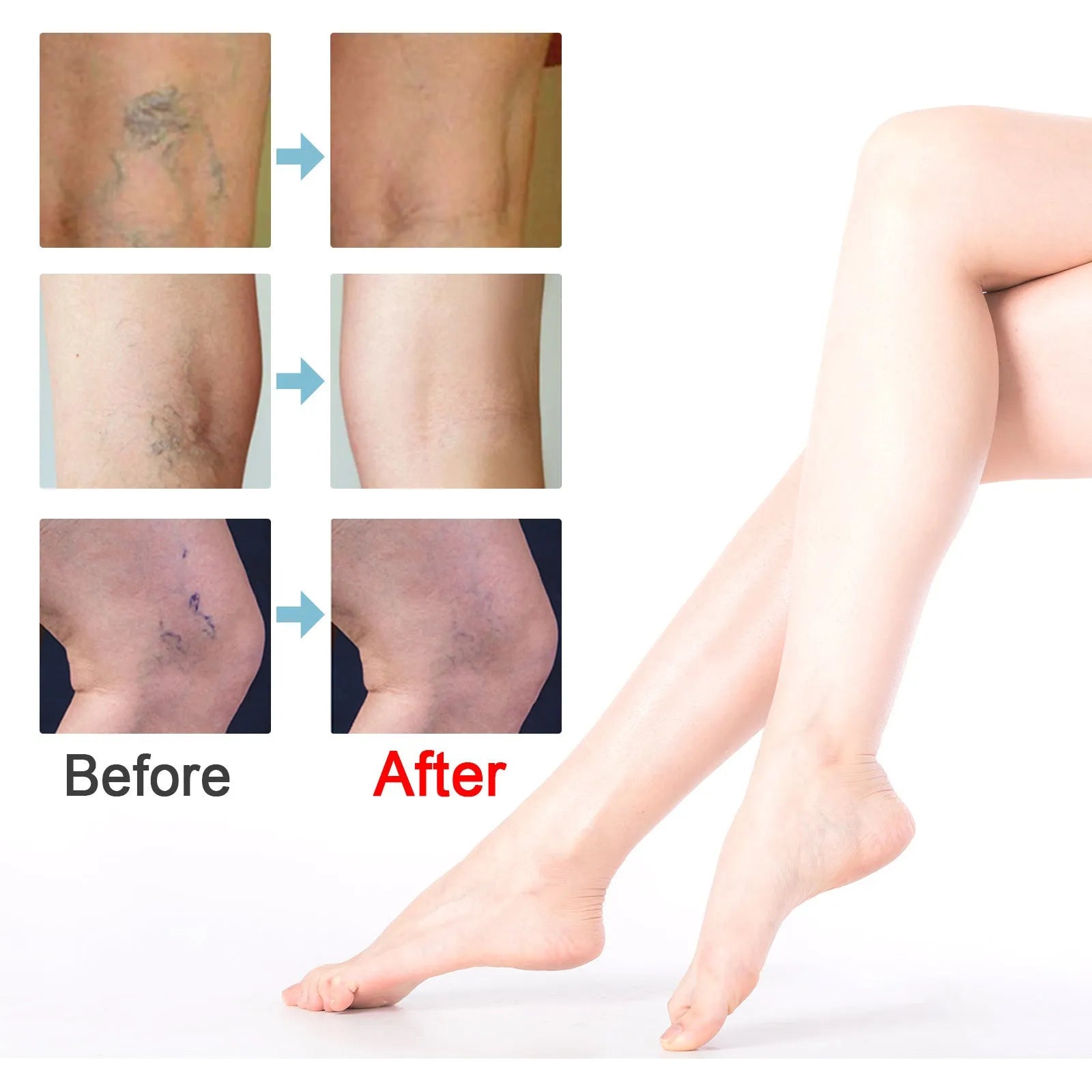 20g tub of vein repair cream for visible leg veins and bulging tendons.