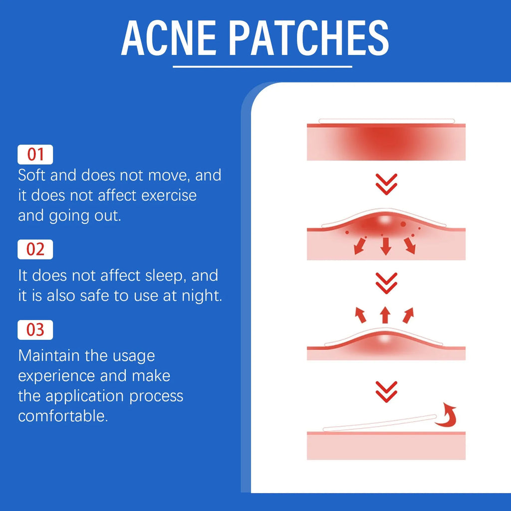 216-count acne patches with tea tree oil and vitamin E for facial care